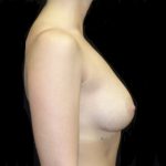Breast Augmentation (Implants) Before & After Patient #20193