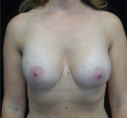 Breast Lift with Implants Before & After Patient #20277