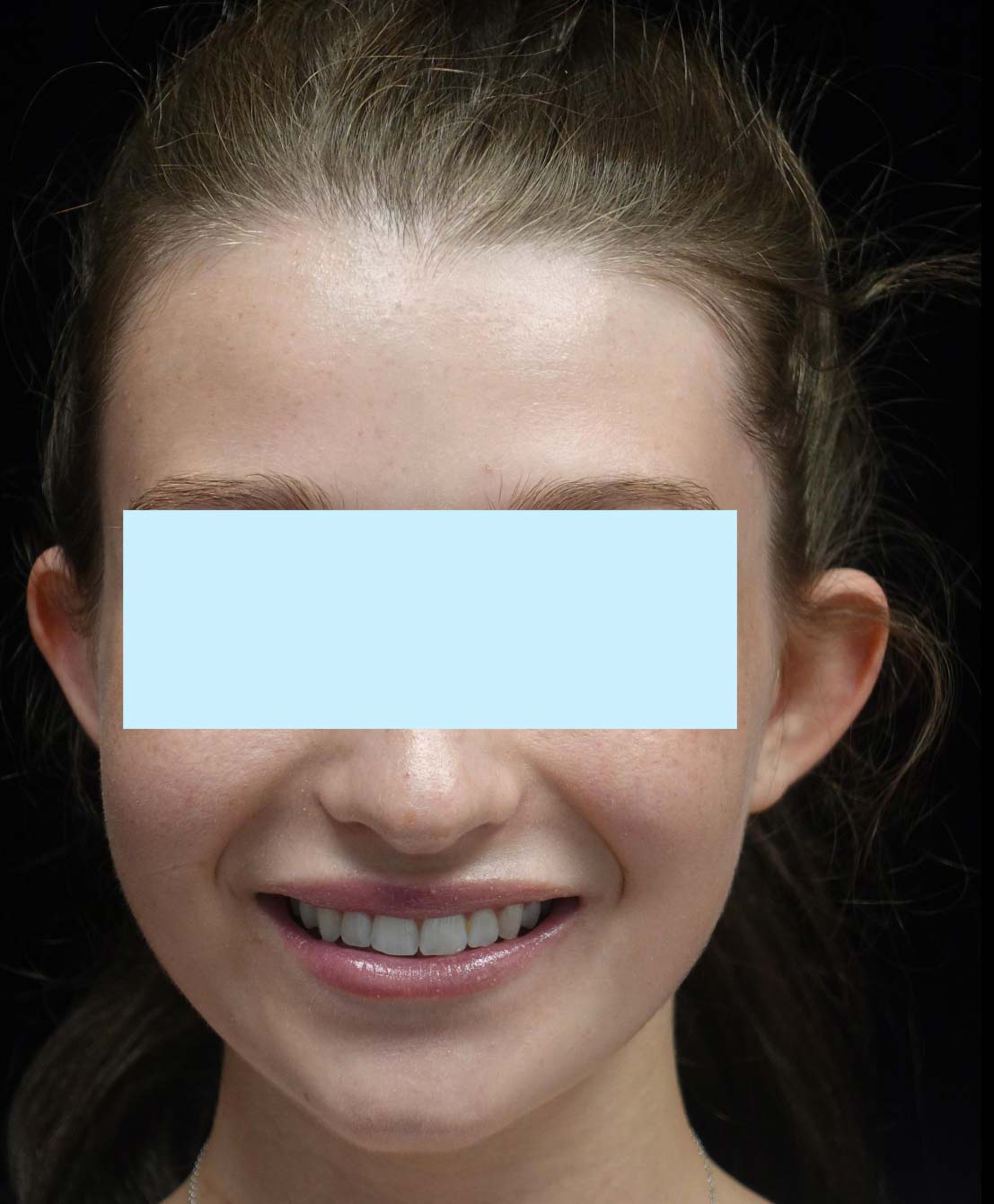 Otoplasty Before & After Patient #20284