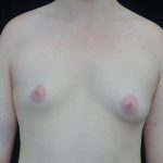 Asymmetric Tuberous Breasts Before & After Patient #20296