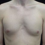 Nipple Inversion Before & After Patient #20297