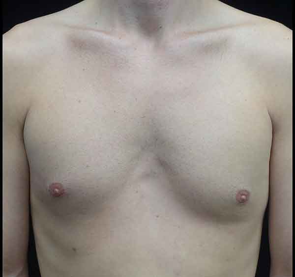 Nipple Inversion Before & After Patient #20297