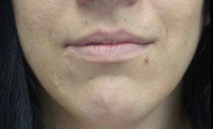 Lip Augmentation - Fillers Before & After Patient #20300