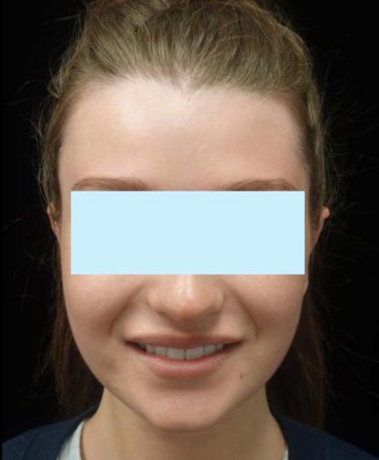 Otoplasty Before & After Patient #20284