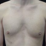 Nipple Inversion Before & After Patient #20297