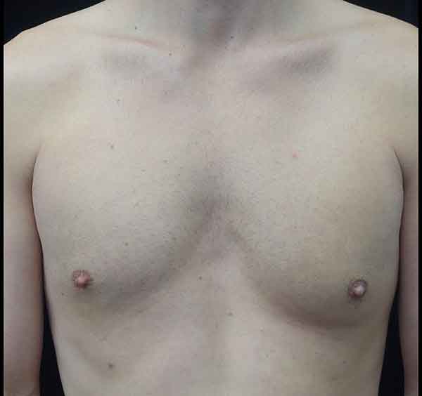 Nipple Inversion Before & After Patient #20297