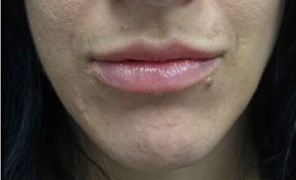Lip Augmentation - Fillers Before & After Patient #20300
