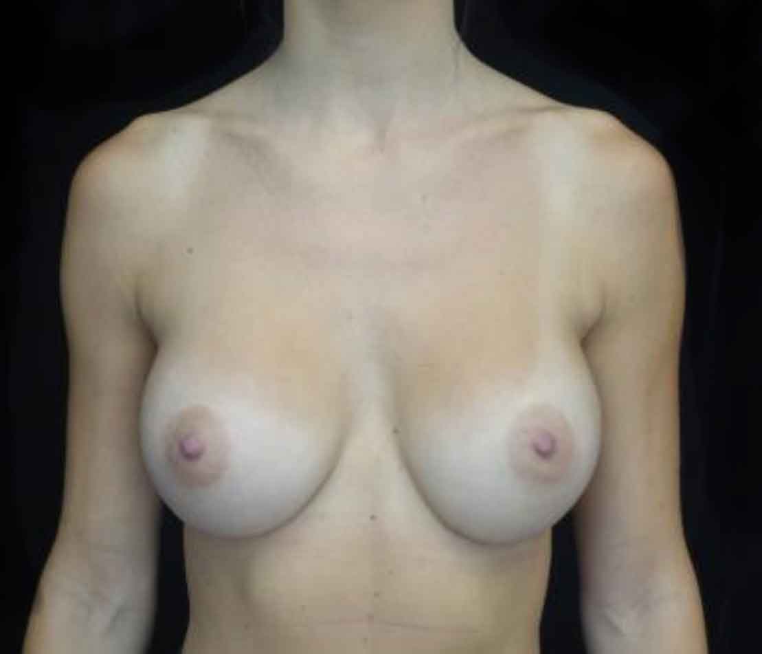 Breast Augmentation (Implants) Before & After Patient #20208