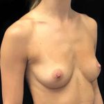 Breast Augmentation (Implants) Before & After Patient #20208