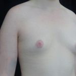 Breast Augmentation (Implants) Before & After Patient #20289