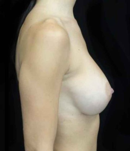 Breast Augmentation (Implants) Before & After Patient #20208