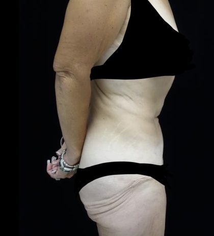Patient #20215 Fleur-de-lis Tummy Tuck Before and After Photos Pittsburgh,  PA - Plastic Surgery Gallery Dr. Anna Wooten