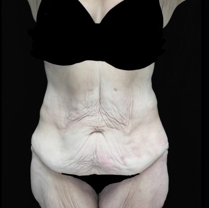 Fleur-de-lis Tummy Tuck Before & After Patient #20215