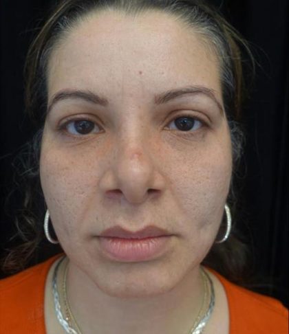 Lip Augmentation - Fillers Before & After Patient #20435