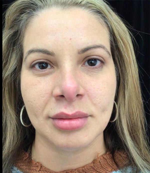 Fillers & Injectables Before & After Patient #20435