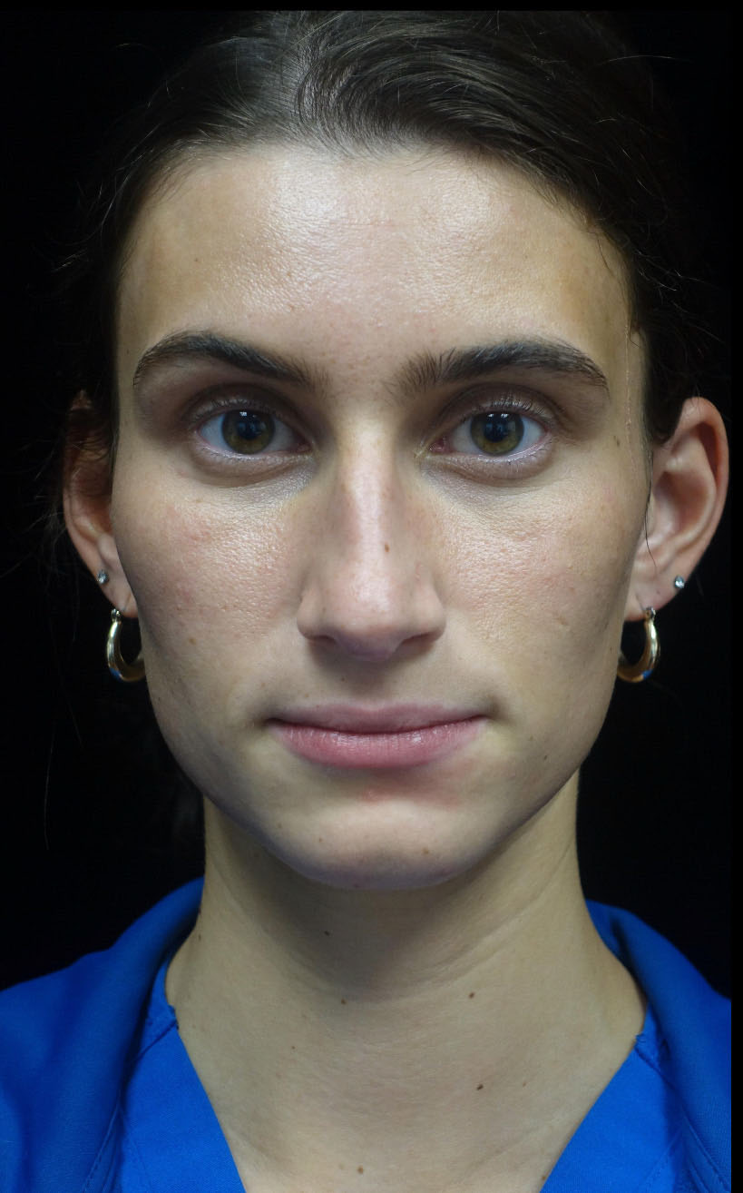Lip Augmentation - Fillers Before & After Patient #20430