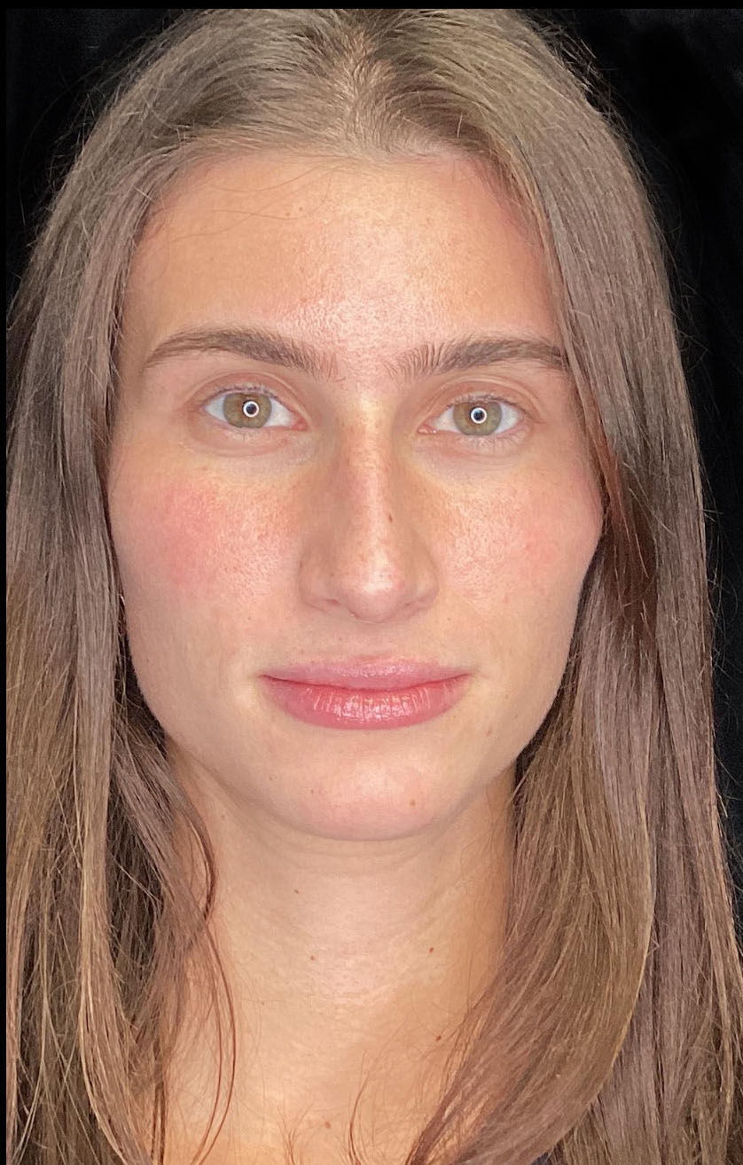 Lip Augmentation - Fillers Before & After Patient #20430