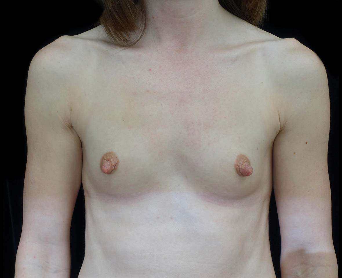 Breast Augmentation (Implants) Before & After Patient #20968