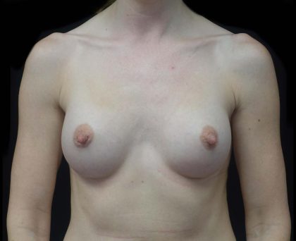 Breast Augmentation (Implants) Before & After Patient #20968