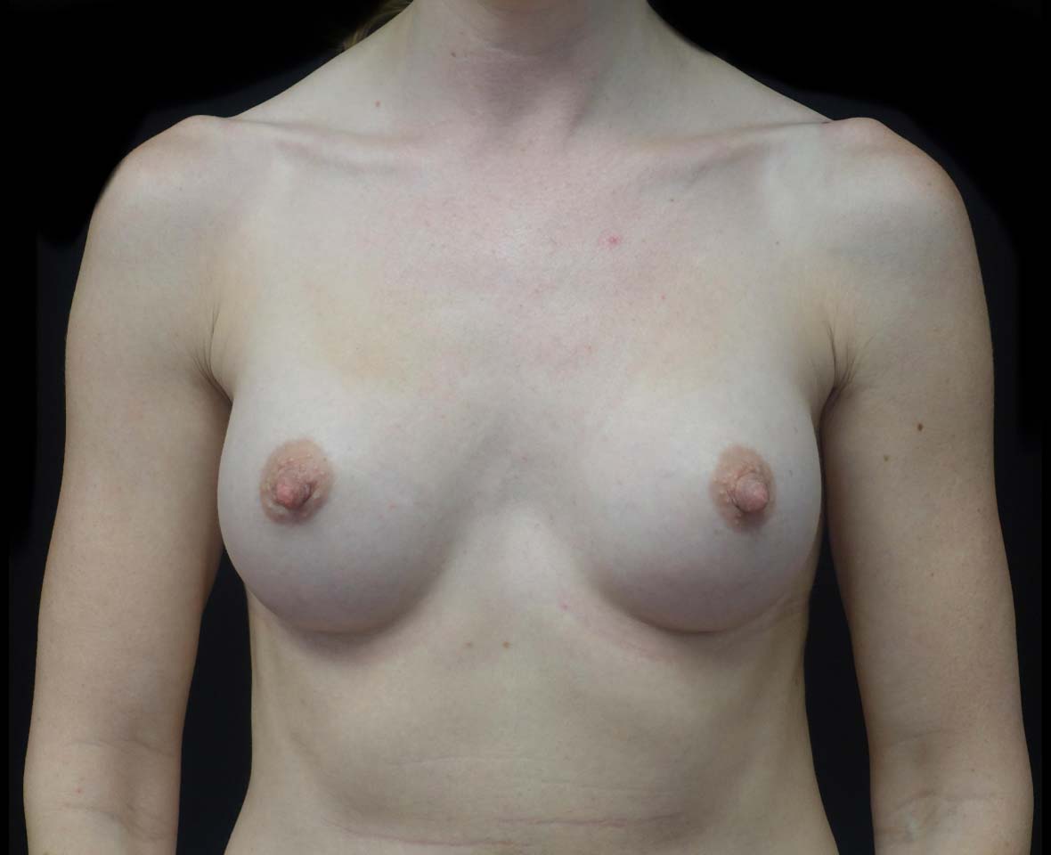 Breast Augmentation (Implants) Before & After Patient #20968