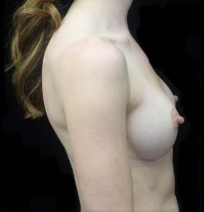 Breast Augmentation (Implants) Before & After Patient #20968