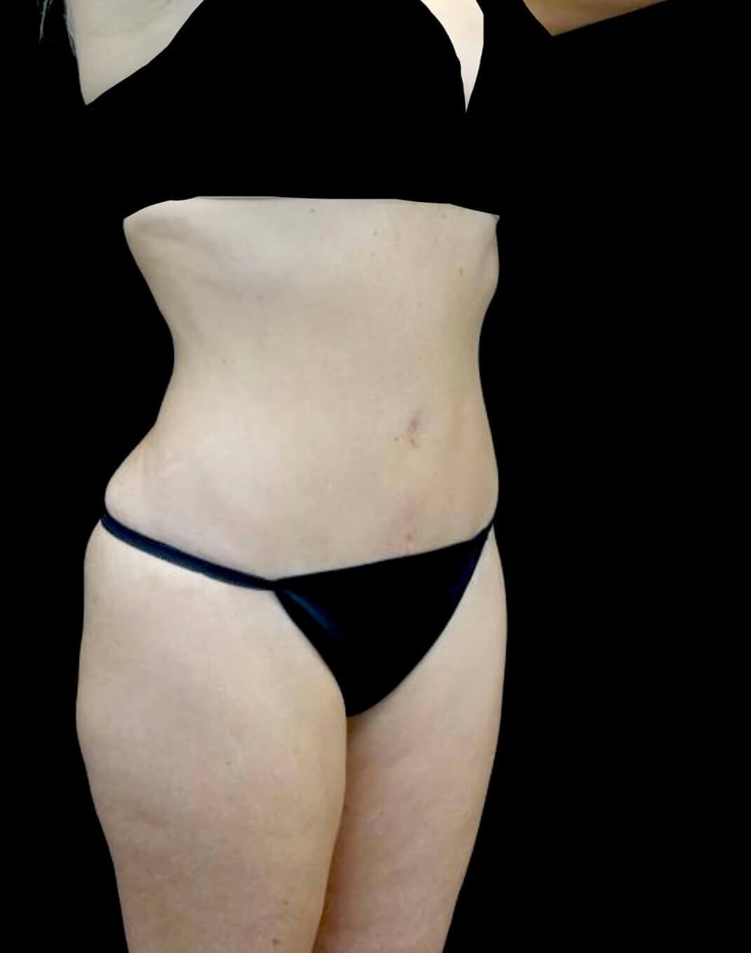 Tummy Tuck Before & After Patient #20986