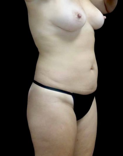 Tummy Tuck Before & After Patient #20986