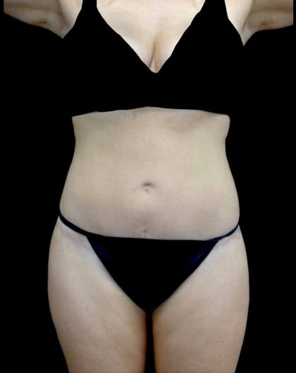 Tummy Tuck Before & After Patient #20986