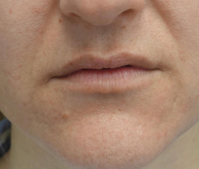 Fillers & Injectables Before & After Patient #21068