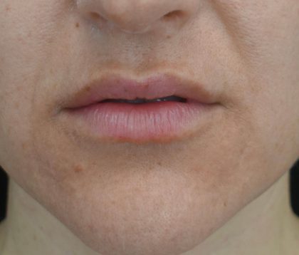 Lip Augmentation - Fillers Before & After Patient #21068