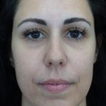 Lip Augmentation - Fillers Before & After Patient #21071