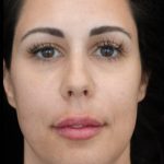Lip Augmentation - Fillers Before & After Patient #21071