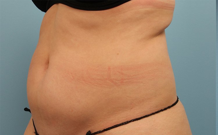 EvolveX Before & After Patient #21077