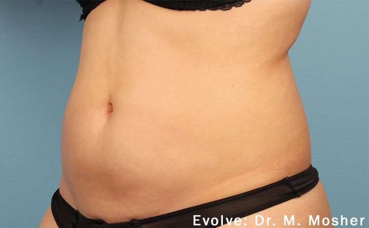 EvolveX Before & After Patient #21077