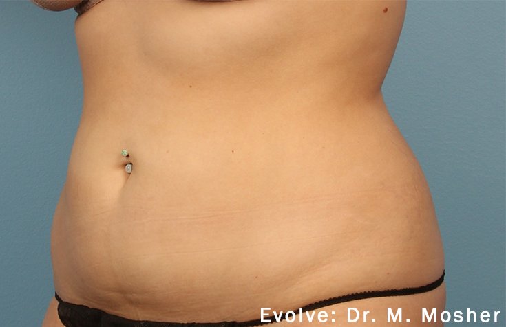 EvolveX Before & After Patient #21080