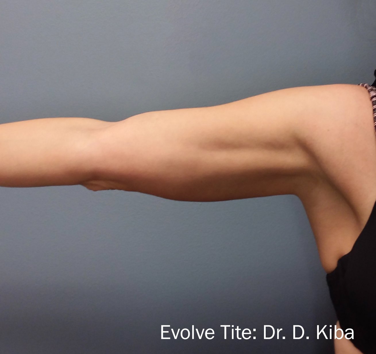 EvolveX Before & After Patient #21086