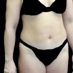 Tummy Tuck Before & After Patient #21124