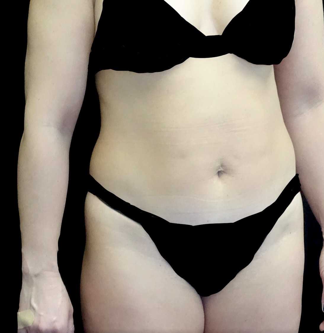 Tummy Tuck Before & After Patient #21124