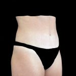 Tummy Tuck Before & After Patient #21124
