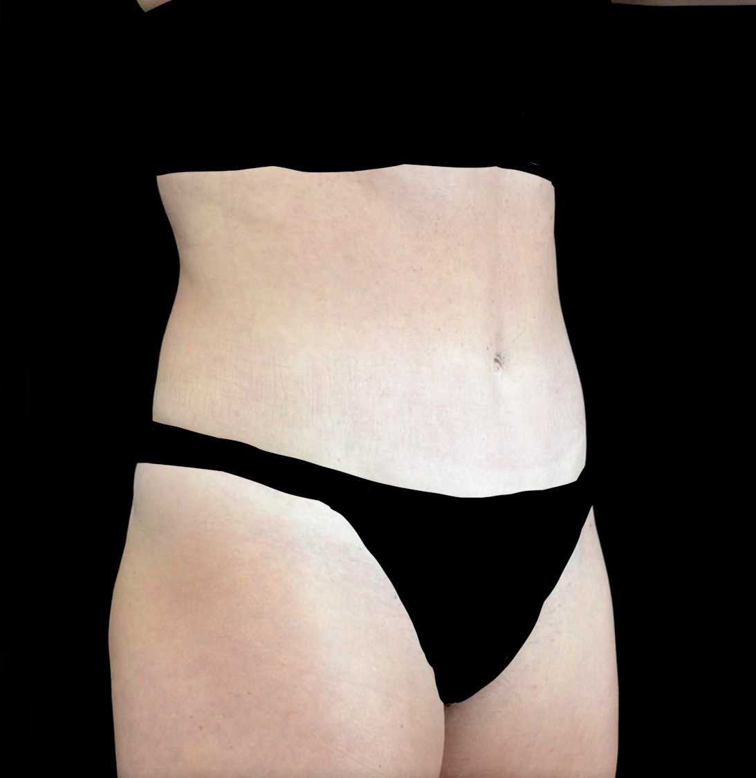 Tummy Tuck Before & After Patient #21124