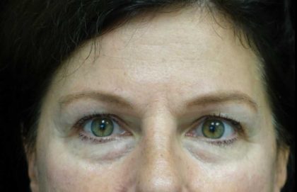 Blepharoplasty Before & After Patient #21133