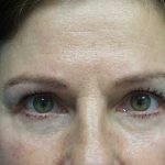 Blepharoplasty Before & After Patient #21133