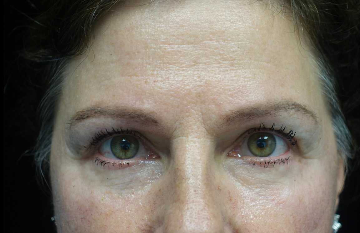 Blepharoplasty Before & After Patient #21133