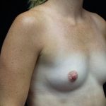 Breast Augmentation (Implants) Before & After Patient #21141