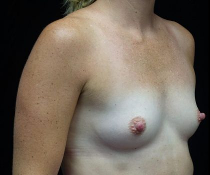 Breast Augmentation (Implants) Before & After Patient #21141