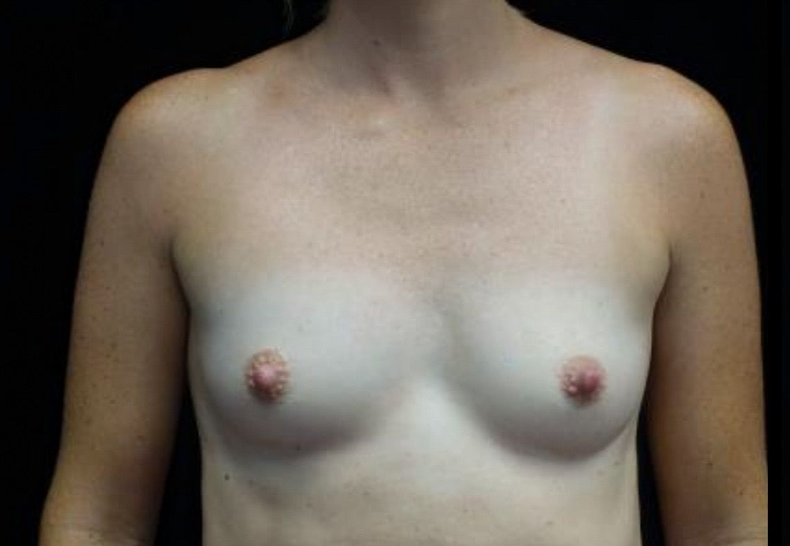 Breast Augmentation (Implants) Before & After Patient #21141