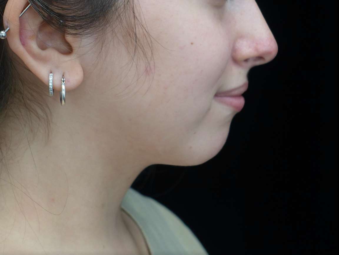 Chin Implants (Augmentation) Before & After Patient #21226