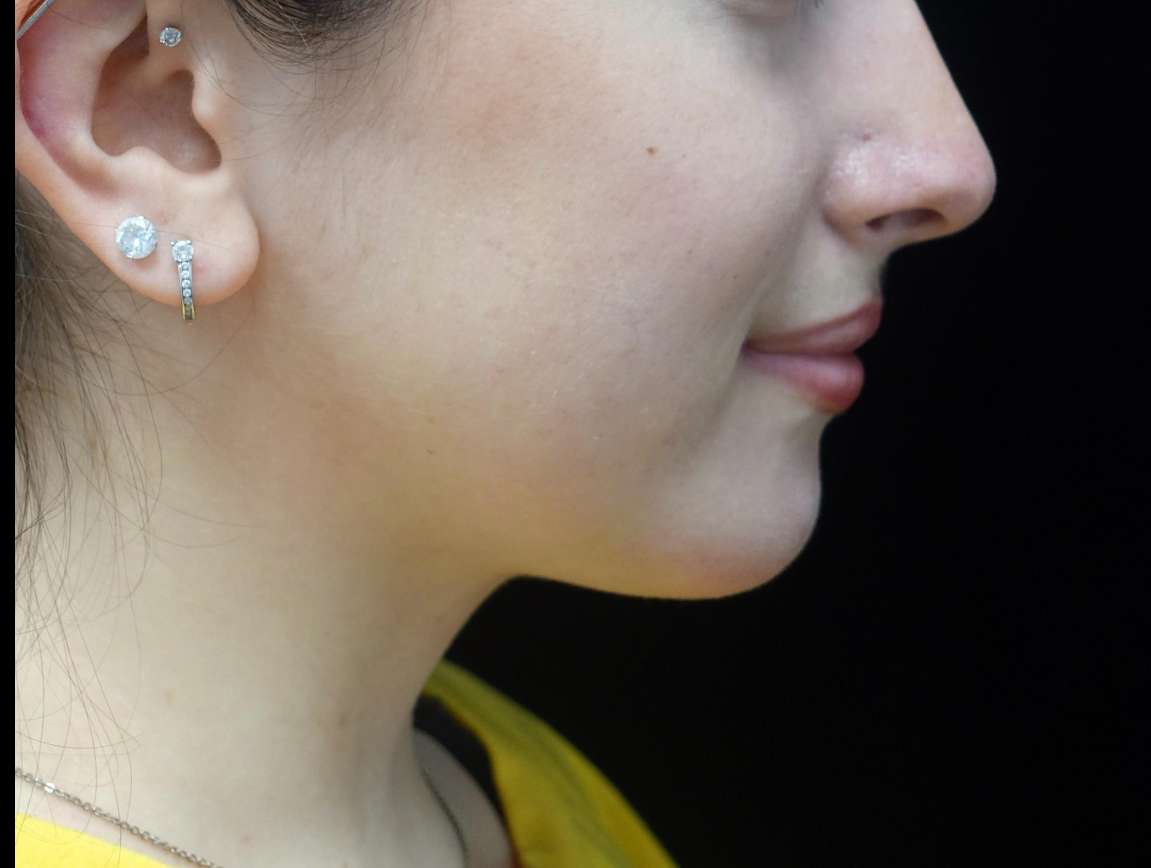 Chin Implants (Augmentation) Before & After Patient #21226