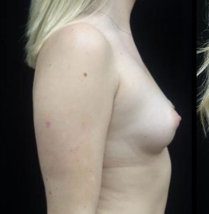 Breast Augmentation (Implants) Before & After Patient #21259