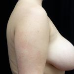 Breast Reduction Before & After Patient #21272